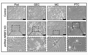 Nature子刊：糖尿病腎病的新靶點可預(yù)防終末期腎衰竭