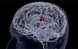 PNAS：將侵襲性癌細(xì)胞重新編程為無(wú)害的癌細(xì)胞