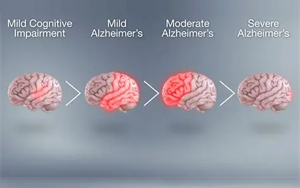 基因-代謝組-飲食互作在癡呆風(fēng)險中的精準預(yù)防：APOE4純合子特異性代謝通路與地中海飲食的調(diào)控作用