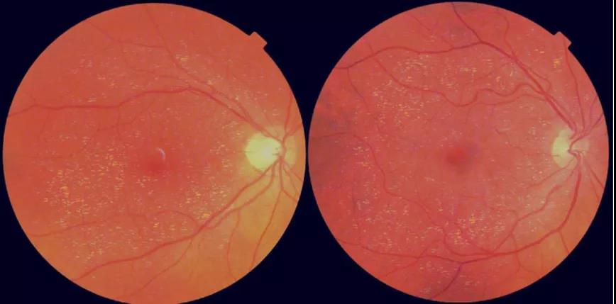 眼睛竟是“年齡之窗”？視網(wǎng)膜年齡差距或可預測壽命長短