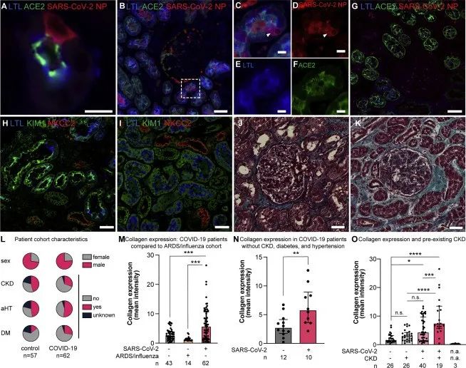 新冠病毒存在于感染者的腎細(xì)胞中并誘導(dǎo)腎臟纖維化