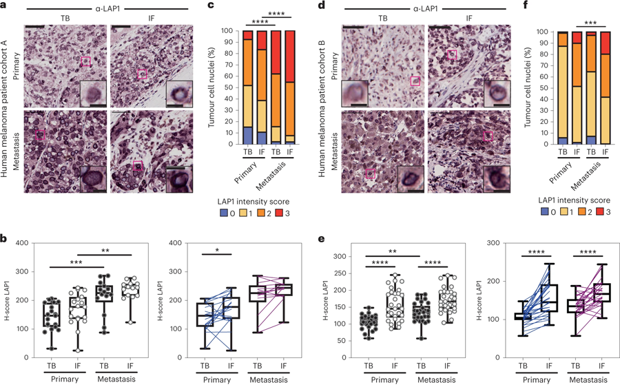 LAP1水平在人類黑色素瘤進(jìn)展中增加