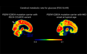 Nature Medicine發(fā)現(xiàn)了新的基因變異，可以預防阿爾茨海默病