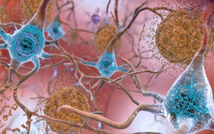 阿爾茨海默病:斑塊里不僅有tau和淀粉樣蛋白 還有衰老驅(qū)動的數(shù)百種蛋白質(zhì)積聚 解密之鑰或藏其中