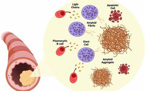 NEJM綜述：淀粉樣變性的發(fā)病機(jī)制、研究和治療