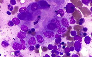 《Science》發(fā)現(xiàn)乳腺癌與大腦的“高速通路”——神經(jīng)元